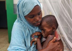A malnourished child in a hospital in Mogadishu, Somalia